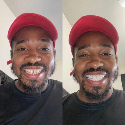 SERA™ Veneer Clip-Ons